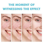 Acne Treatment Cream & Pimple Remover for Face