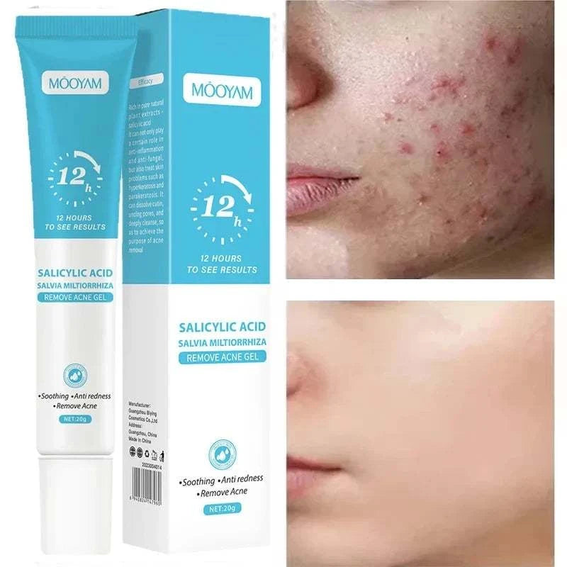 Acne Treatment Cream & Pimple Remover for Face