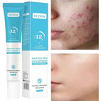 Acne Treatment Cream & Pimple Remover for Face