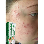 Severe Acne & Cystic Pimple Treatment Cream