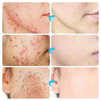 Acne Treatment Cream & Pimple Remover for Face