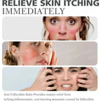 Severe Acne & Cystic Pimple Treatment Cream