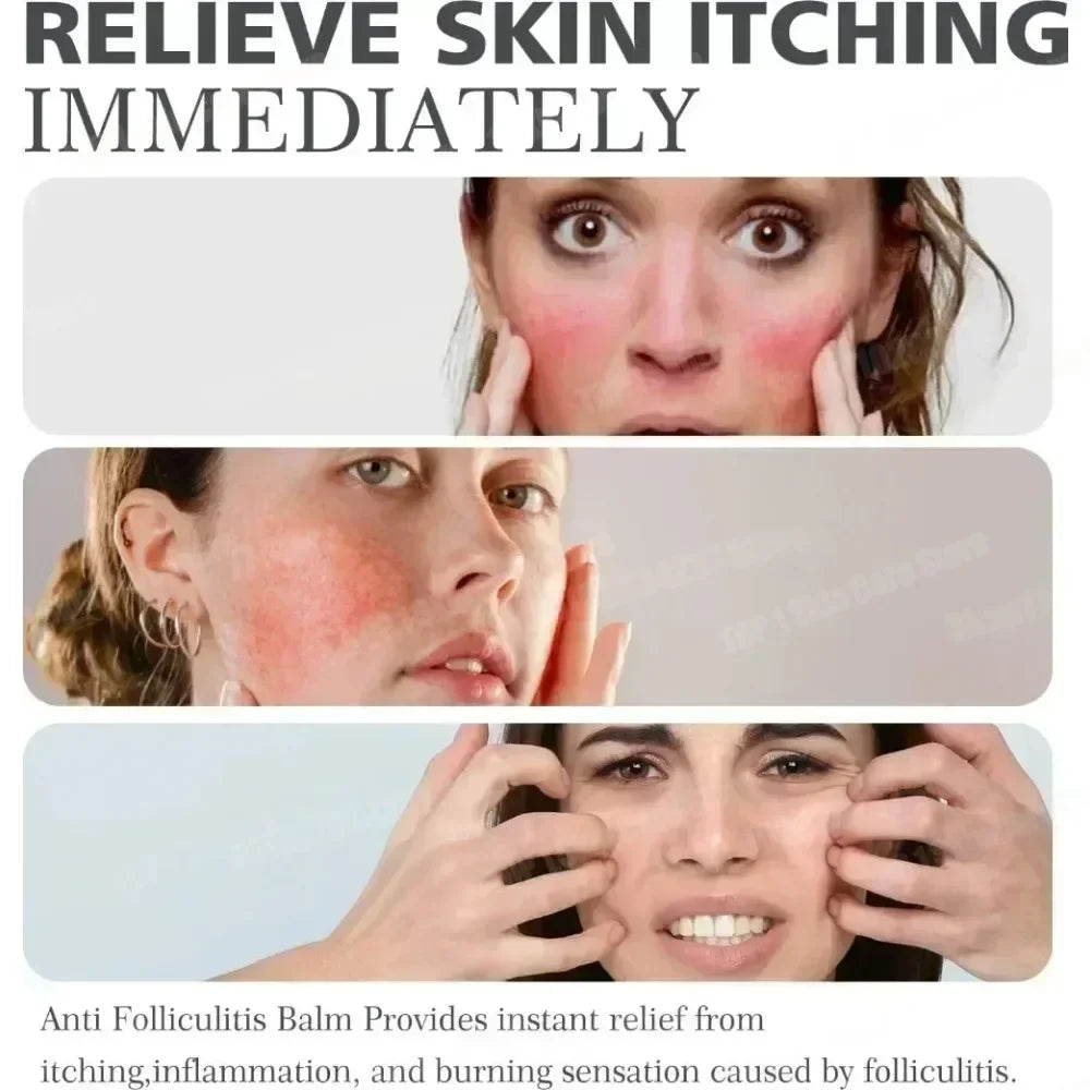 Severe Acne & Cystic Pimple Treatment Cream