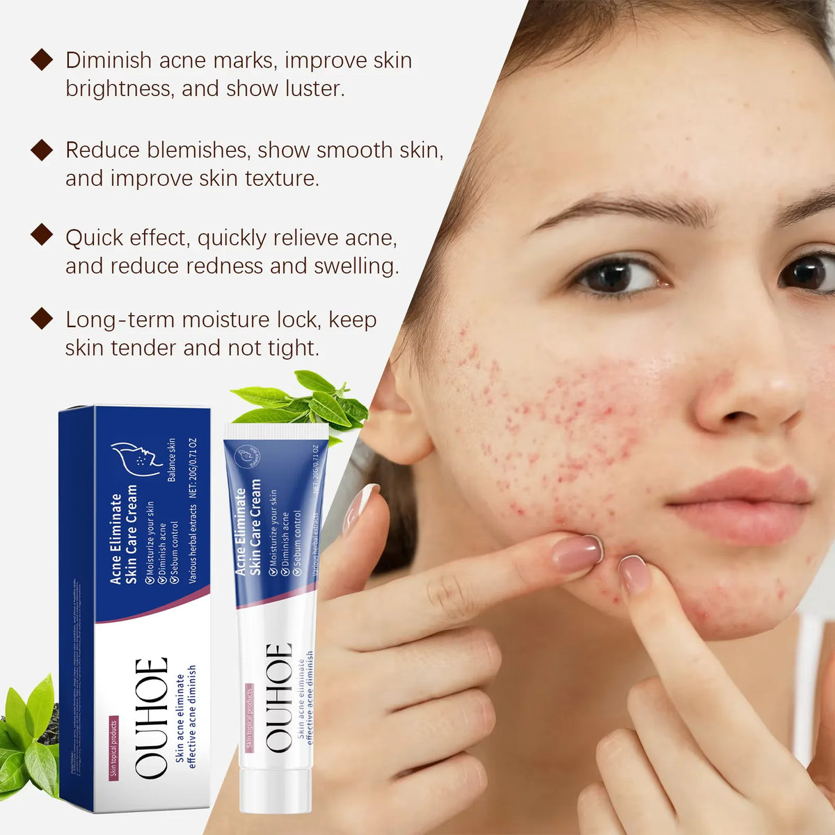 Oil-Control Pimple & Acne Repair Face Cream