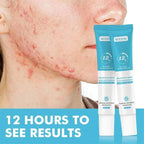 Acne Treatment Cream & Pimple Remover for Face