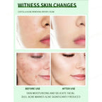 Severe Acne & Cystic Pimple Treatment Cream