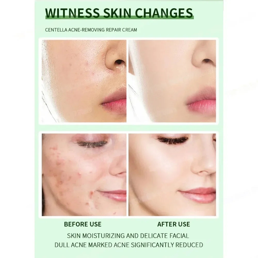 Severe Acne & Cystic Pimple Treatment Cream