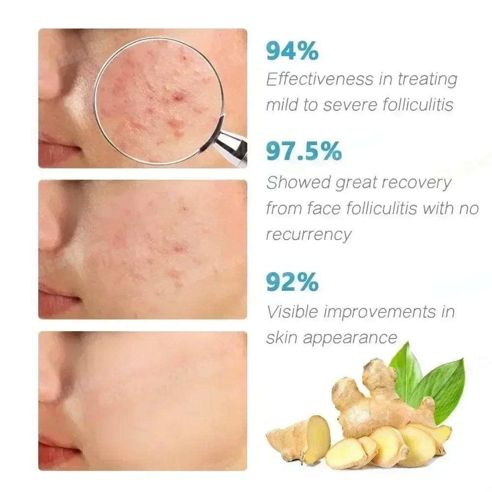 Severe Acne & Cystic Pimple Treatment Cream