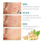 Severe Acne & Cystic Pimple Treatment Cream