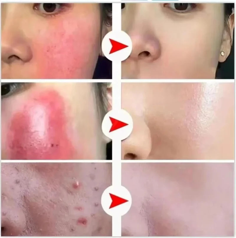 Korean Redness Relief Cream for Sensitive Skin & Rosacea